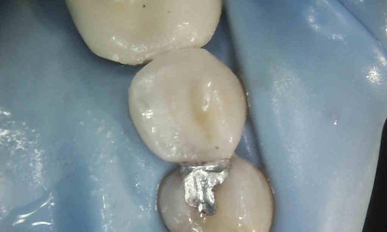 Silver-Filling-Replacement-with-Composite-Restoration-After-Image
