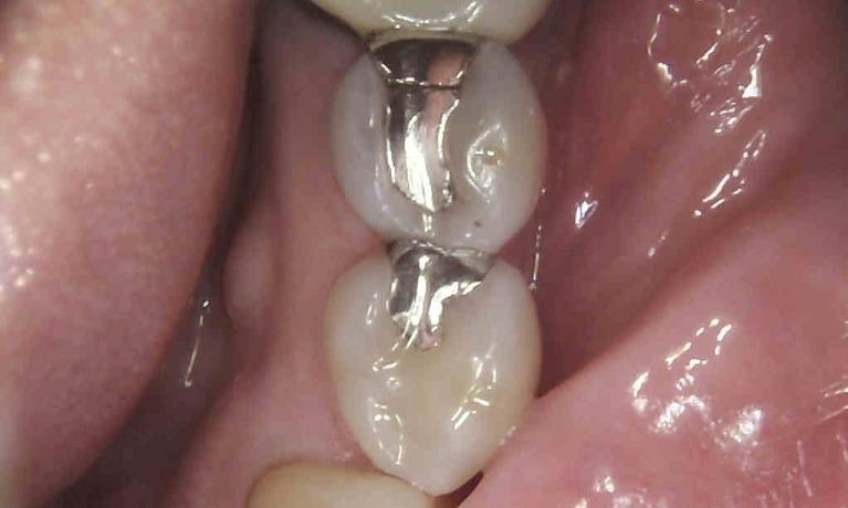 Silver-Filling-Replacement-with-Composite-Restoration-Before-Image